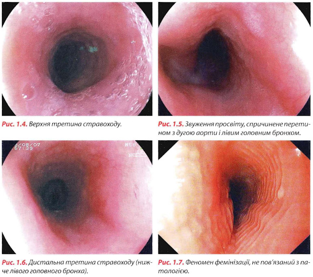 Ендоскопічна картина стравоходу в нормі