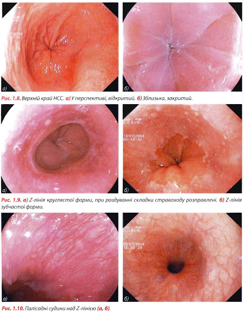 Ендоскопічна картина стравоходу в нормі