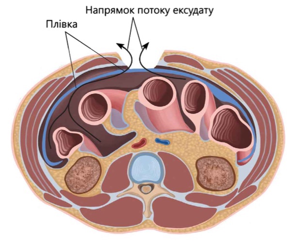 Рис. 2.4. Схема використання плівки при лапаростомі