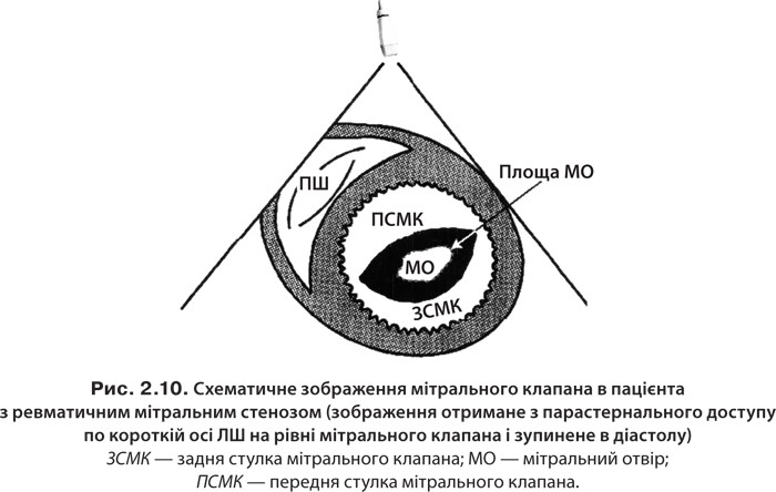 Мітральний клапан