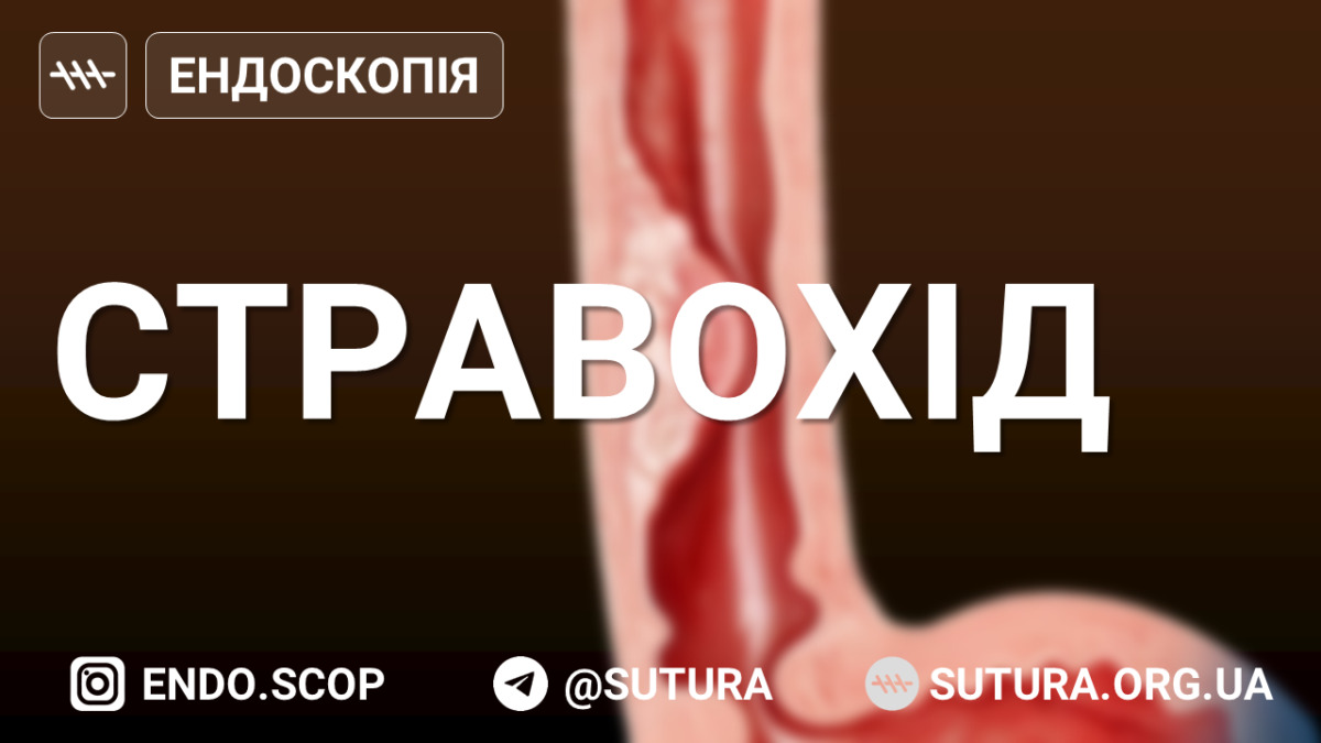 Ендоскопія стравоходу Ендоскопічна картина стравоходу в нормі