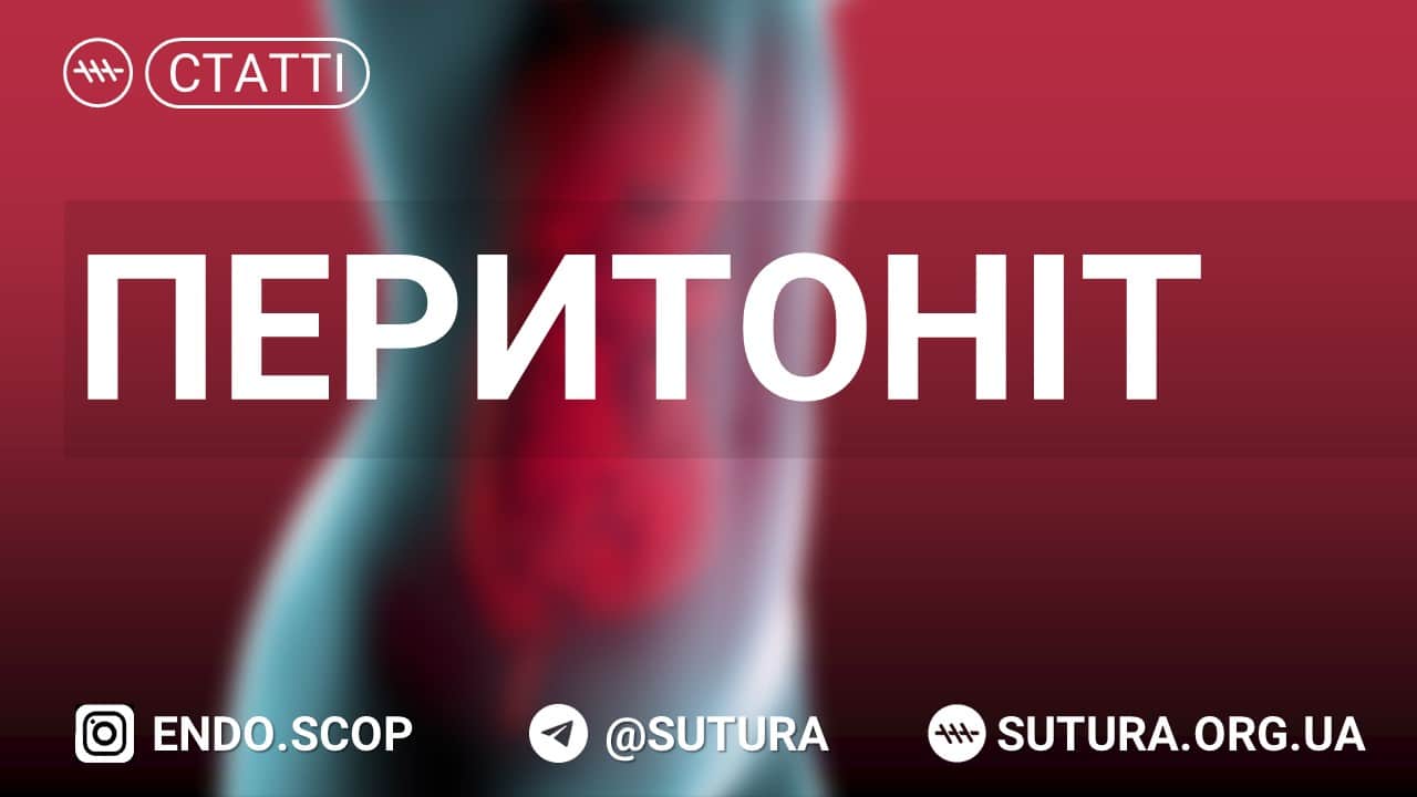 Гострий перитоніт. Клінічна картина, діагностика та диференційна діагностика, тактика лікування. Відмежований перитоніт. Окремі клінічні форми перитоніту