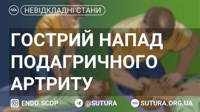 Дебют (загострення) подагри, обумовлений швидкою зміною рівня сечової кислоти у плазмі крові.