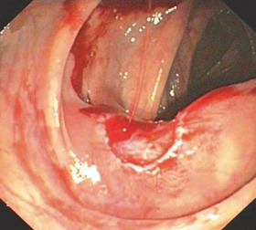 Рис. 1.16 Артеріальна кровотеча після поліпектомії