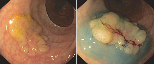 Рис. 1.22 Підслизова ін'єкція аденоми. Плоска нативна аденома. b Плоска аденома після підслизової ін’єкції розчину толуїдинового синього
