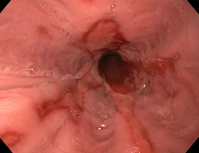 Важкий рефлюкс-езофагіт – LA ступінь D: злиті ерозії, що поширюються понад три чверті окружності (циркулярні дефекти).