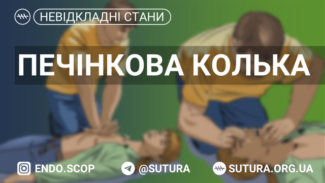 Стан, що викликають конкременти, які перешкоджають вільному відтоку жовчі, гостре розтягнення міхура або жовчних шляхів вище перешкоди. Найбільш характерний синдром жовчнокам’яної хвороби.